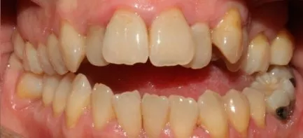 ortodoncia-fija-antes1