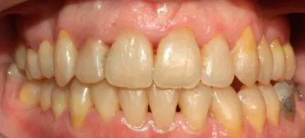 ortodoncia-fija-despues1