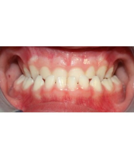 ortodoncia-infantil-antes1
