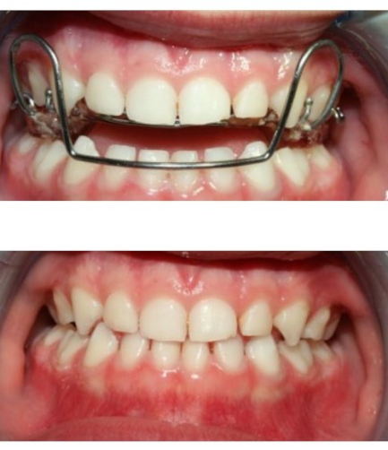 ortodoncia-infantil-despues1