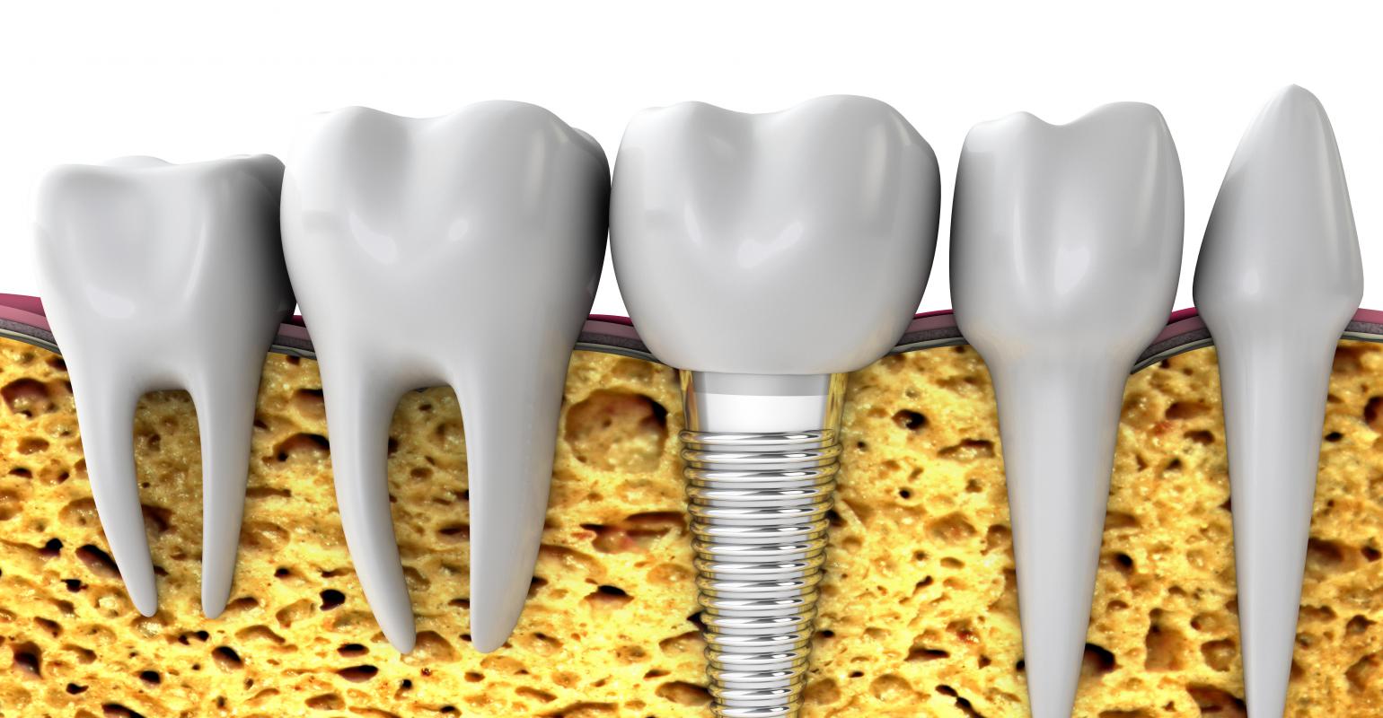 blog-implantes-dentales