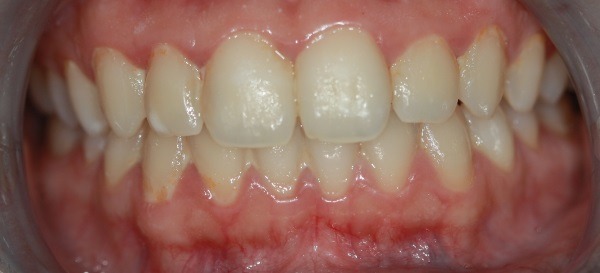 Antes