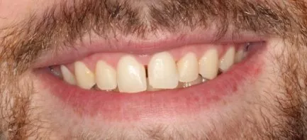 Antes