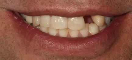 Antes