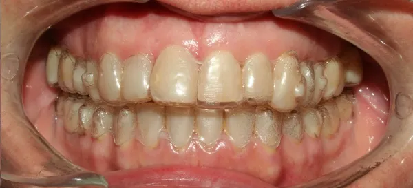 Antes
